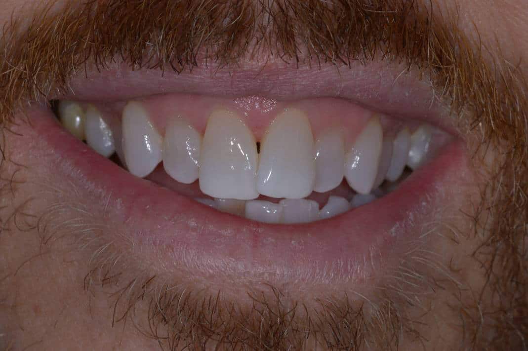 Aligners-upper-arch-1