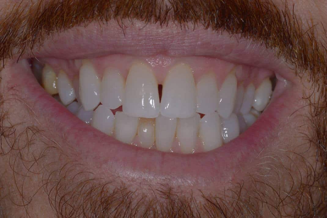 Aligners-upper-arch-2