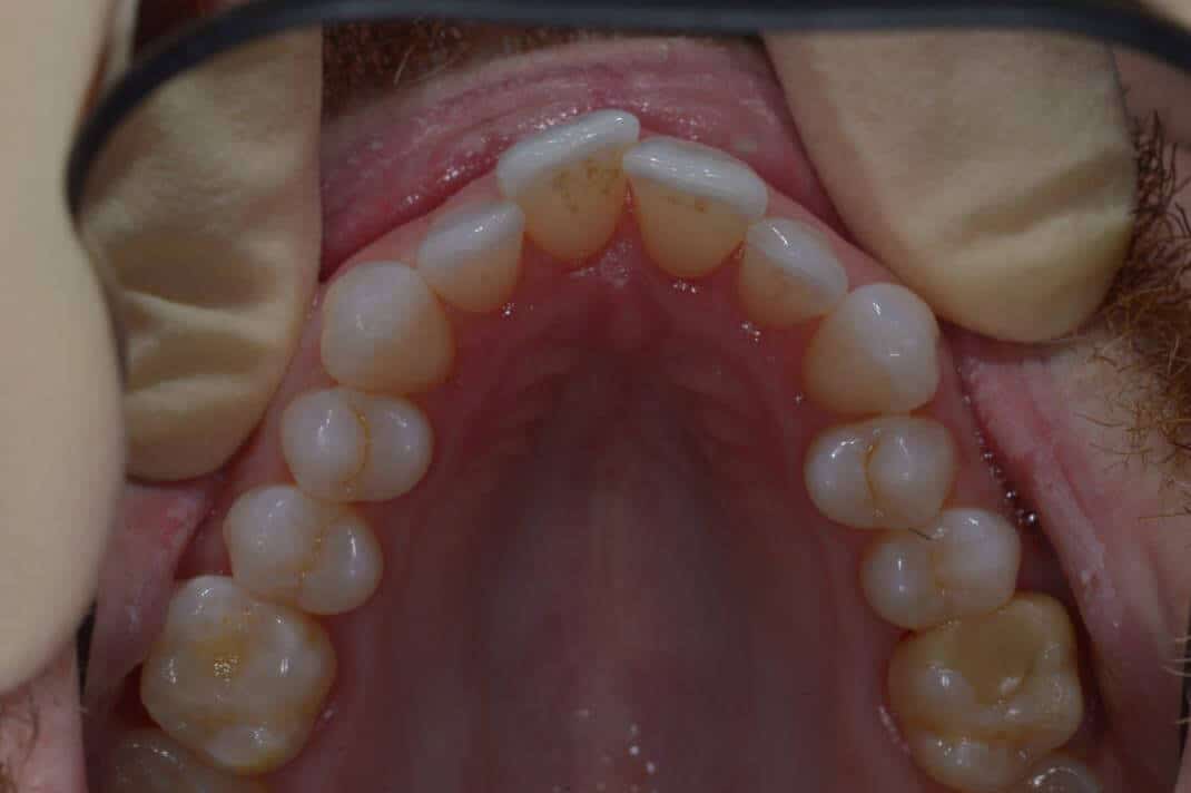 Aligners-upper-arch-3