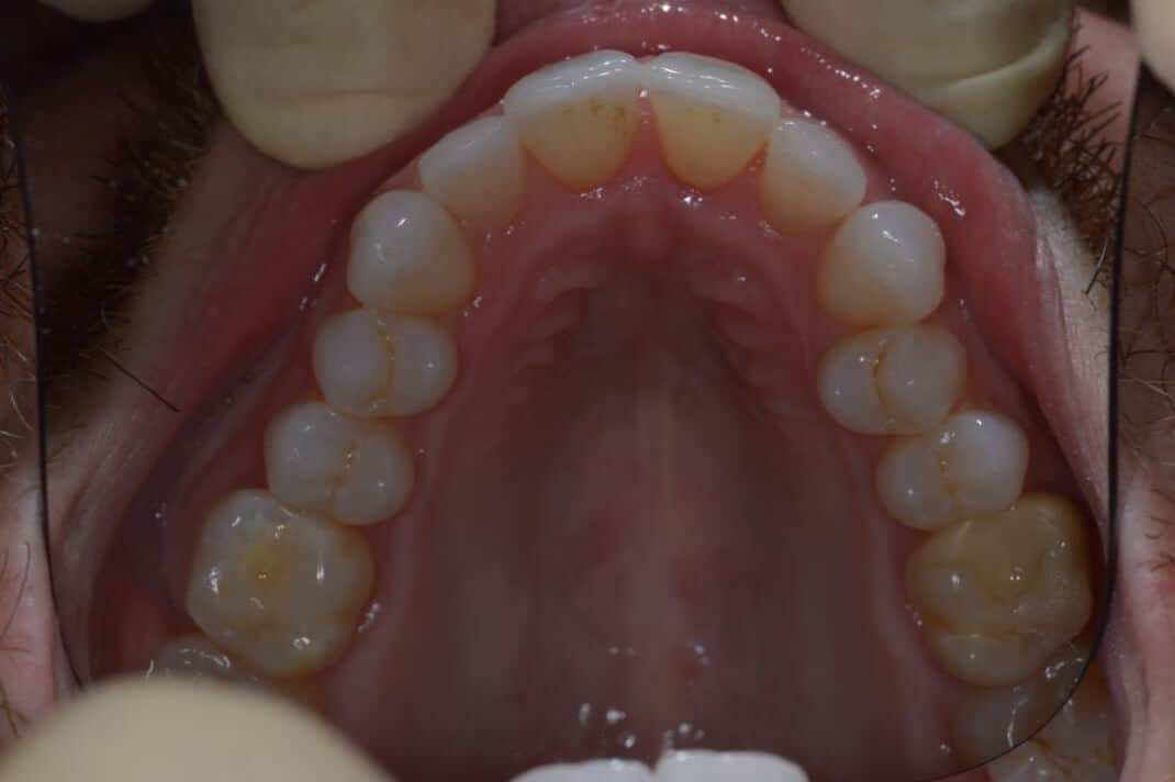 Aligners-upper-arch-4