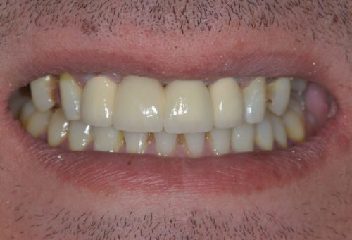 After image