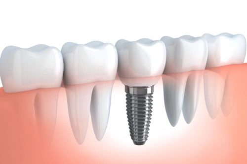 Bristol-Dental-Implants-Cost