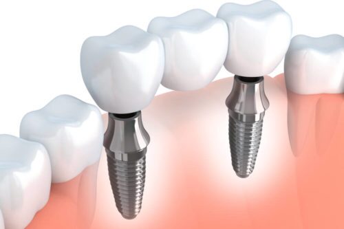 Dental-Implants-Practice-Bristol