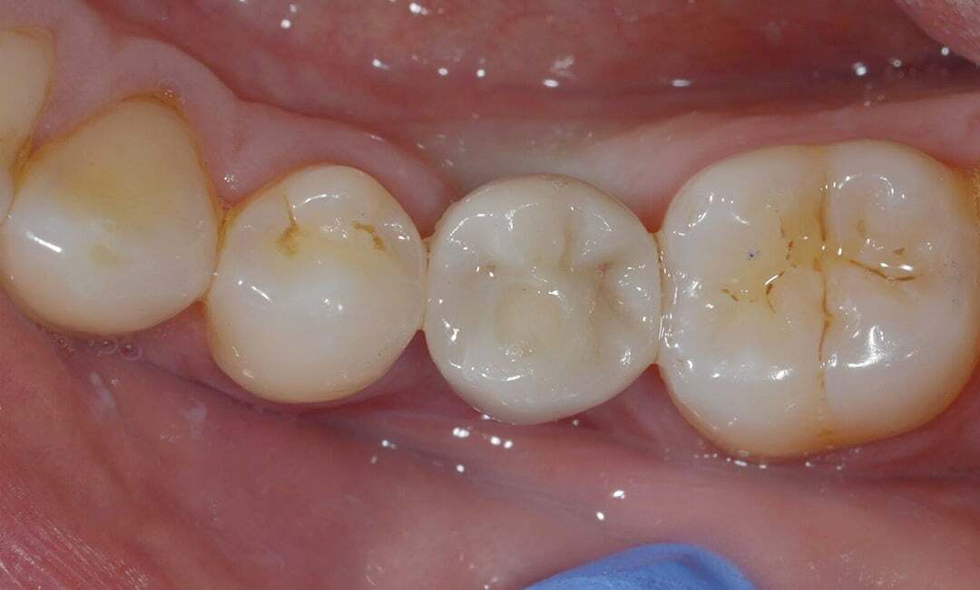 After image