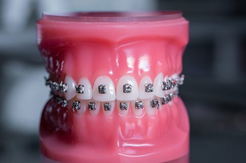 Fixed-Braces Fixed-Braces